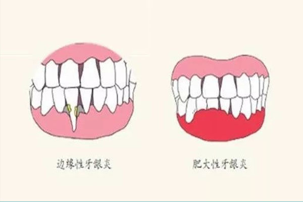 刷牙方式不正确导致牙龈萎缩怎么办