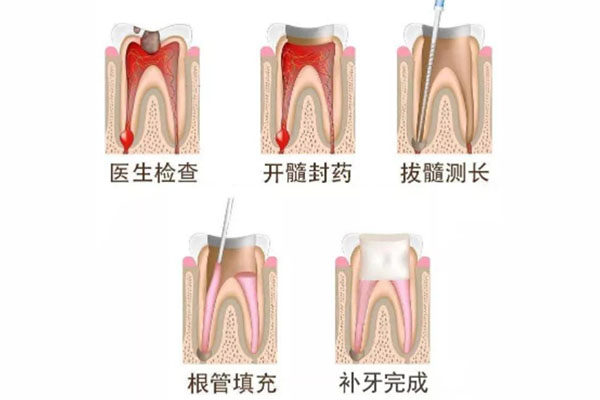 补牙临时填充材料能用多久(补牙临时填充材料是什么成分)