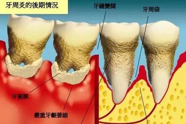 牙周炎控制住了牙龈还会萎缩吗(牙周炎控制住了牙龈还会萎缩吗