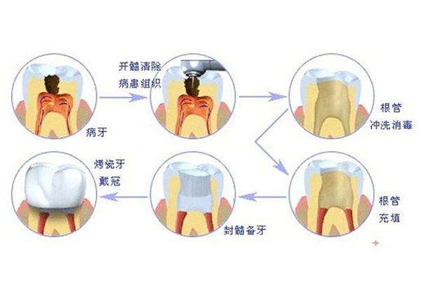 补完牙齿后牙痛怎么缓解(补完牙齿后牙痛怎么缓解一下)