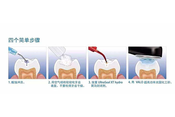 涂氟对牙齿有伤害吗(涂氟对牙齿有伤害吗)