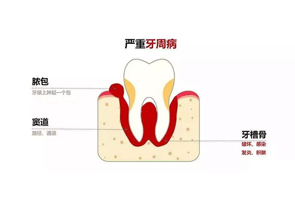 老年人牙周炎治疗方案有哪些种类(老