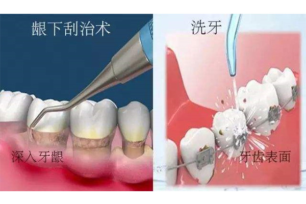 3岁小孩牙齿钙化怎么治疗最好呢(3岁