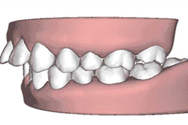 牙齿矫正天包地怎么矫正不伤牙齿(牙