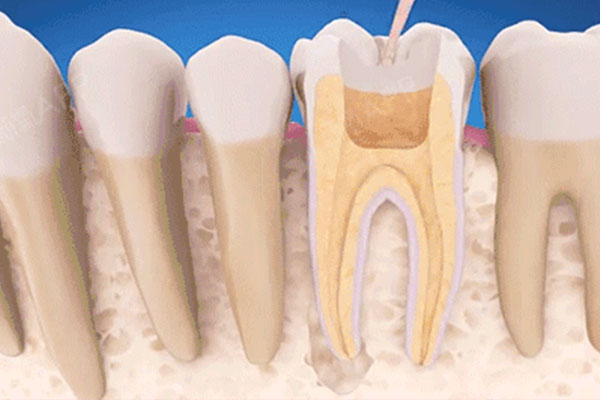 后槽牙根管治疗过程(后槽牙根管治疗