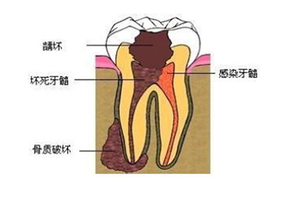 有蛀牙怎么搞掉(有蛀牙怎么搞掉牙结石)