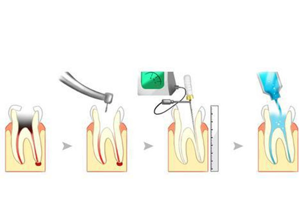 怎么知道根管治疗成功(怎么知道根管
