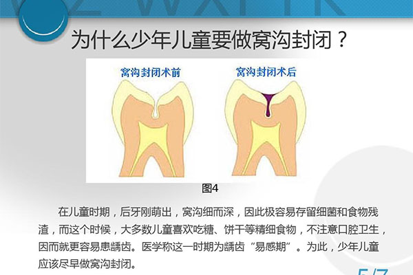 儿童口腔涂氟的好处(儿童口腔涂氟的好处有形成保护屏障吗)