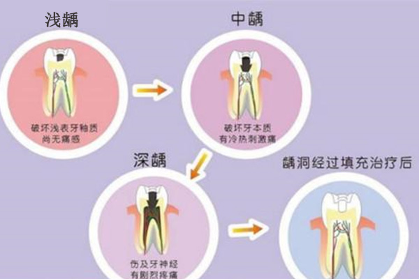 虫牙已经空了怎么办(虫牙已经空了怎么办还疼)