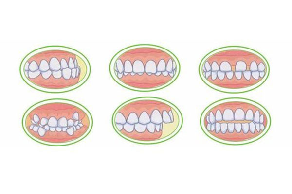 孩子牙齿上下咬合不齐(孩子牙齿上下