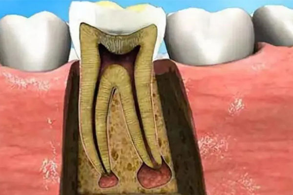 牙髓炎分几类(牙髓炎分几类)