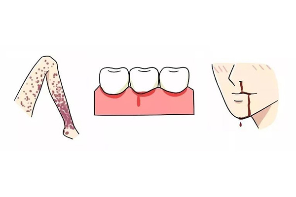 刷牙牙龈老出血怎么回事打消炎针就不出血了呢