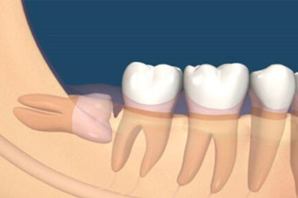 什么是智齿  症状