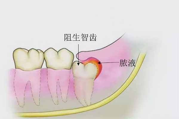 拔智齿牙根断在里面要紧吗而且还缝针了会怎么样(拔智齿牙根断