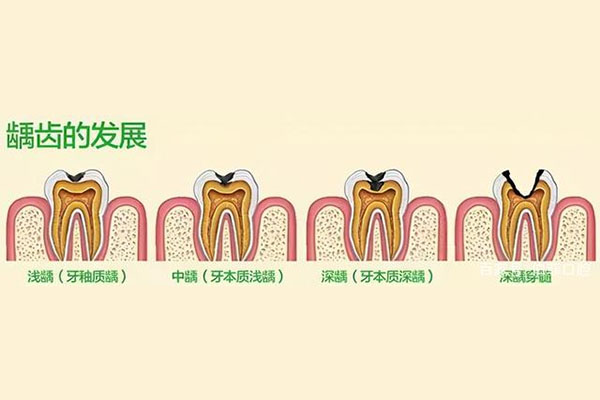 孩子长虫牙是怎么回事(孩子长虫牙是怎么回事啊)