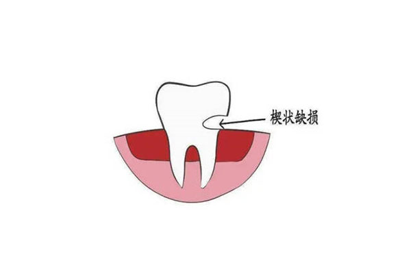 刷牙不当导致牙齿缺损吗怎么办