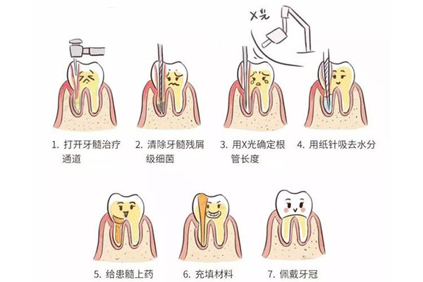 牙齿楔状缺损补牙容易掉吗多少钱(牙