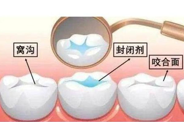 6岁儿童窝沟封闭做几颗牙(六岁孩子做窝沟封闭多少钱)