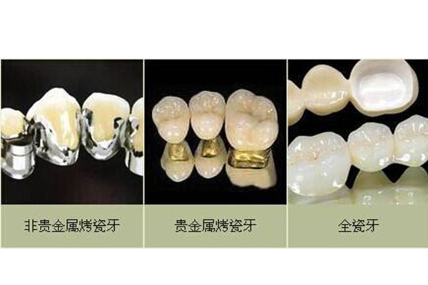 深圳洋紫荆全瓷牙价格(深圳市洋紫荆