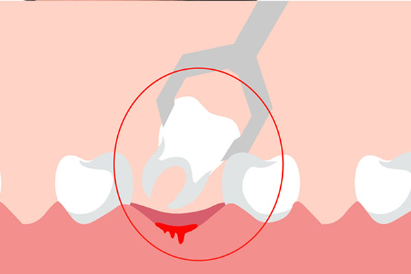拔牙为什么要不疼的时候拔(拔牙为什么要不疼的时候拔掉)