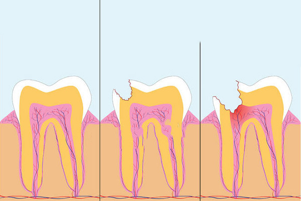 牙体缺损的临床表现有哪些(牙体缺损的临床表现有哪些特点)