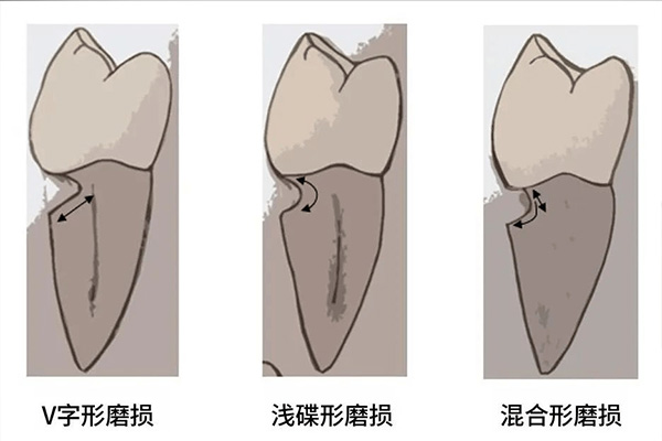 牙体缺损的修复原则(牙体缺损的修复原则是什么)