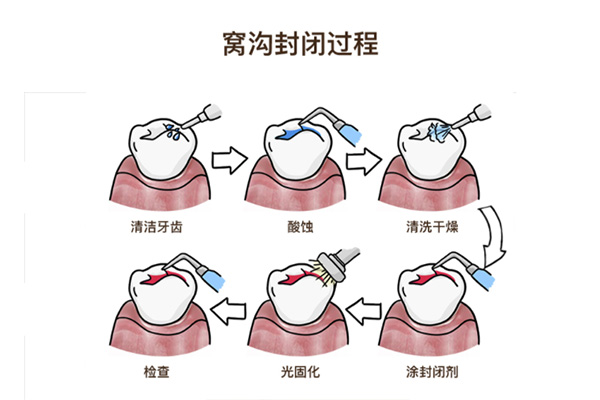 七岁换牙期还需要涂氟吗(七岁换牙期