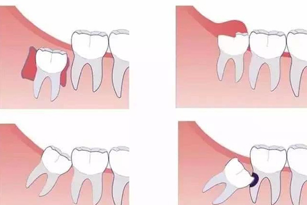 拔智齿的危害与风险(拔智齿的危害与