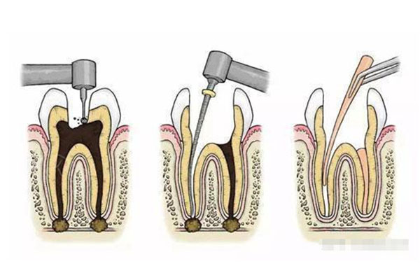 根管治疗是牙髓炎吗(根管治疗是牙髓