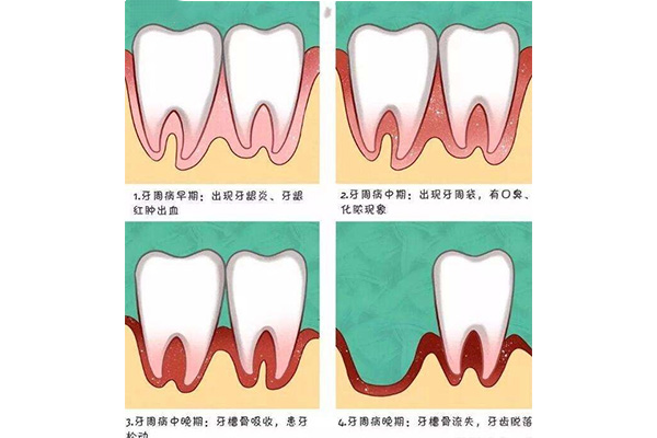 牙周炎患者常伴的症状是(牙周炎患者