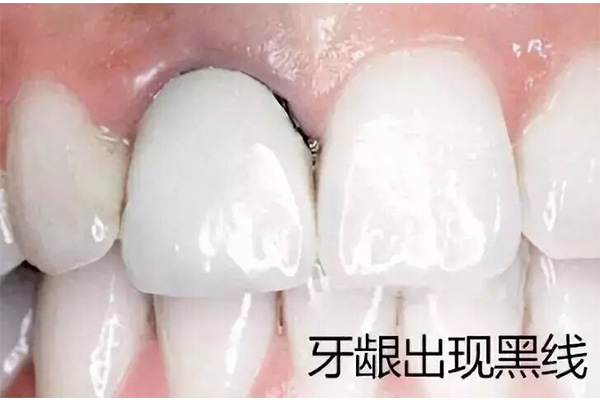 牙周炎萎缩的牙龈可以恢复吗怎么治