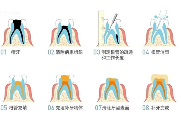 牙根炎症状做根管治疗通不下去怎么办(牙根炎症状做根管治疗通