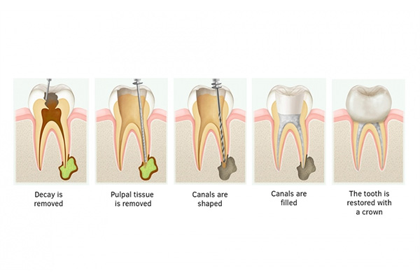 牙医说要做根管治疗什么意思(牙医说