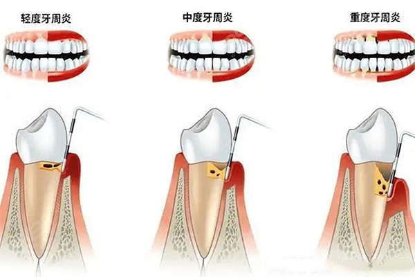 小孩得牙周炎吃什么药好(小孩得牙周