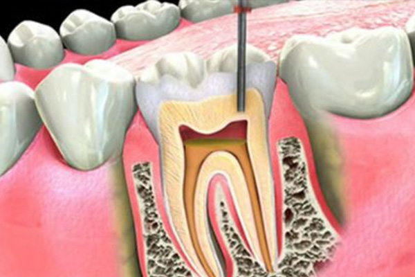 牙根发炎做根管几次能好(牙根发炎做