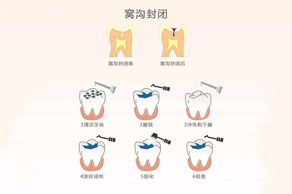 氟斑牙能涂氟吗(氟斑牙可以刷白吗