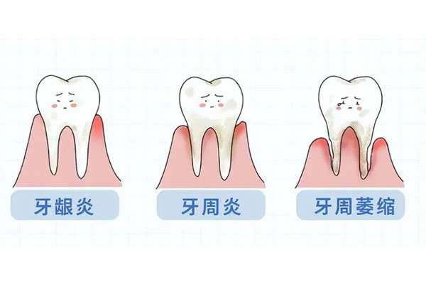 急性牙周炎能自愈吗怎么治疗(急性牙