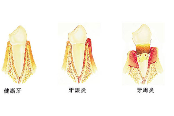 牙周疾病复合体治疗方法(牙周疾病复