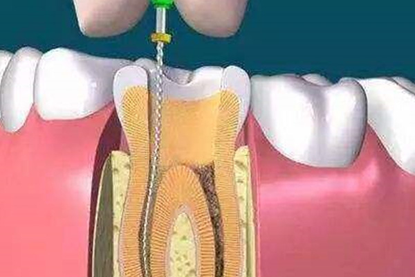 根管治疗一般是什么牙齿(根管治疗一