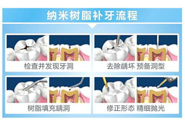 在郑州补个牙多少钱一颗啊(郑州补牙多少钱一颗牙)