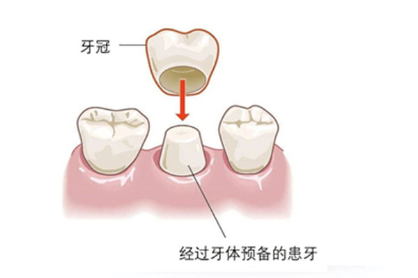 补牙后悔的经历(补牙后悔的经历200字)