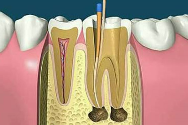 门牙做了根管治疗一定要戴牙冠吗多少钱(门牙做了根管治疗一定