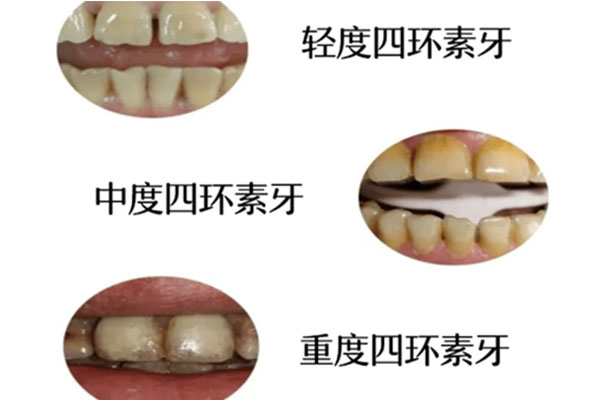 四环素片的作用与危害(四环素片的功