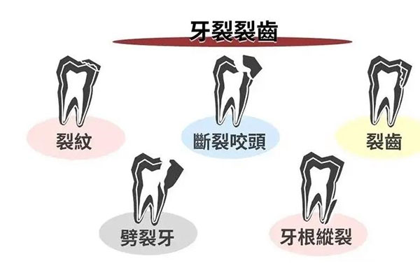 牙列缺损修复的种类(牙列缺损修复的种类有)