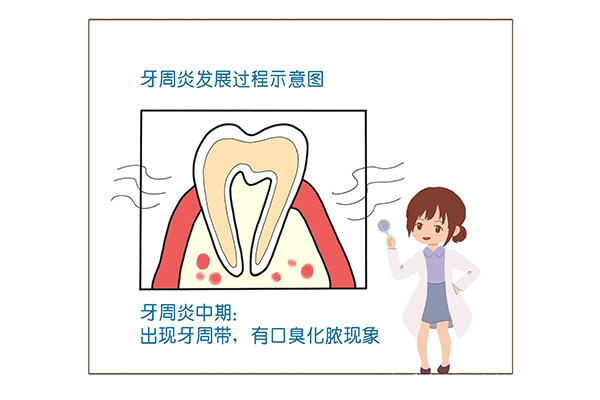 重度牙周炎治疗案例(重度牙周炎治疗案例视频)