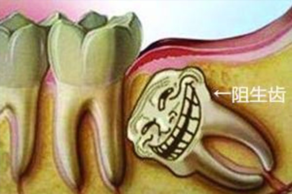 拔智齿疼吃哪种止痛药(拔智齿疼吃哪