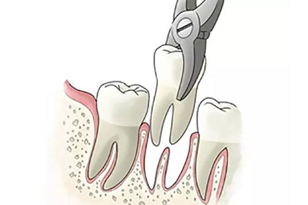 如何在家无痛拔牙齿呢(如何在家无痛拔牙齿呢)