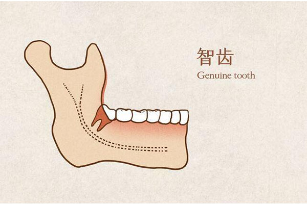 后槽智齿一定要拔吗多少钱一颗(后槽智齿一定要拔吗多少钱一颗