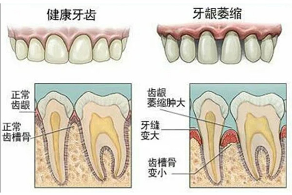 牙龈萎缩牙齿有缝隙怎么办(牙龈萎缩