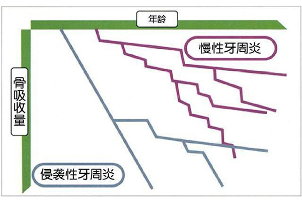 牙周炎的主要原因是什么引起的呢(牙周炎的主要原因是什么引起